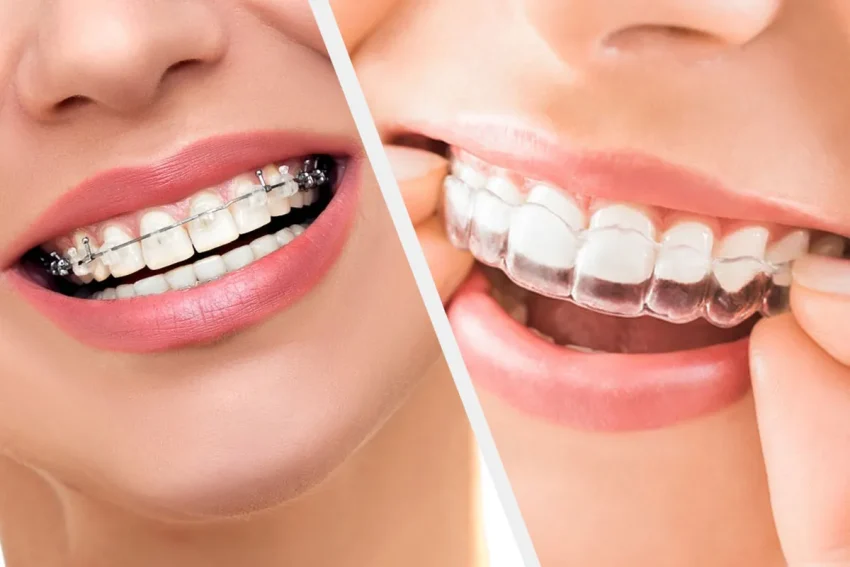 Invisalign: Pioneering Comfort with Adaptive Dental Solutions